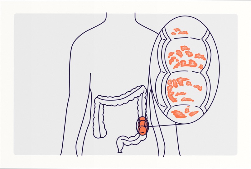 Medical icons and question mark for ulcerative colitis quiz