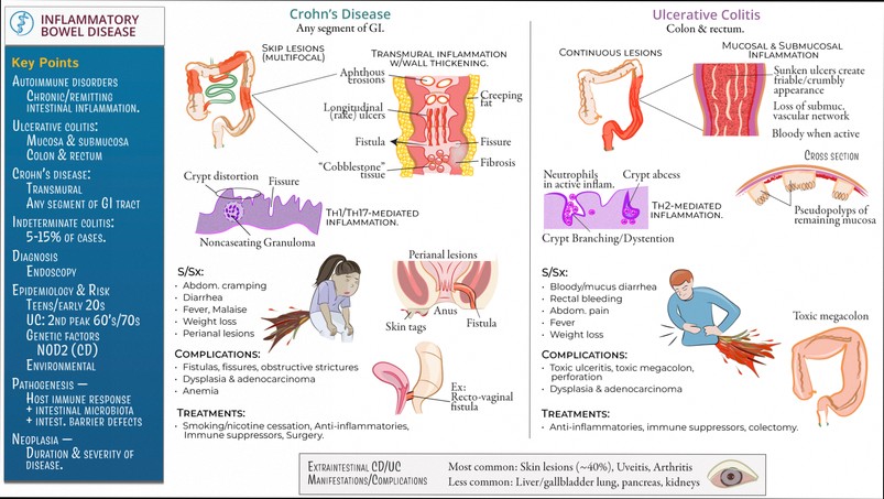 Illustration of symptom checklist for ulcerative colitis quiz